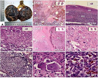 Case Report: Composite pheochromocytoma with ganglioneuroma component: A report of three cases